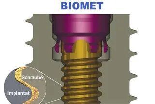 Biomet 3I
